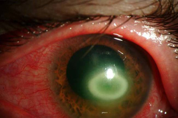Оваа девојка не ги извадила своите контактни леќи 6 месеци и нешто застрашувачко се случило со нејзините очи