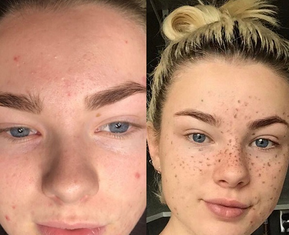 Тетовирање пеги на лицето: Нов тренд за убавина кој изгледа неодоливо