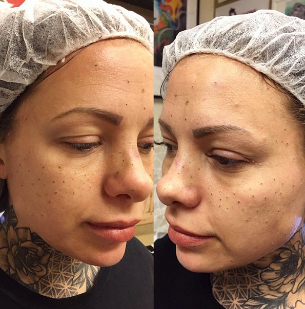 Тетовирање пеги на лицето: Нов тренд за убавина кој изгледа неодоливо