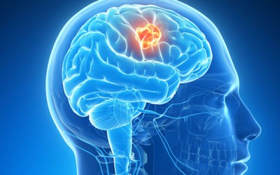 7 рани симптоми на рак кои 90% од луѓето ги игнорираат