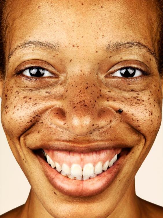 Фотограф прави неверојатни портрети од луѓе со пеги