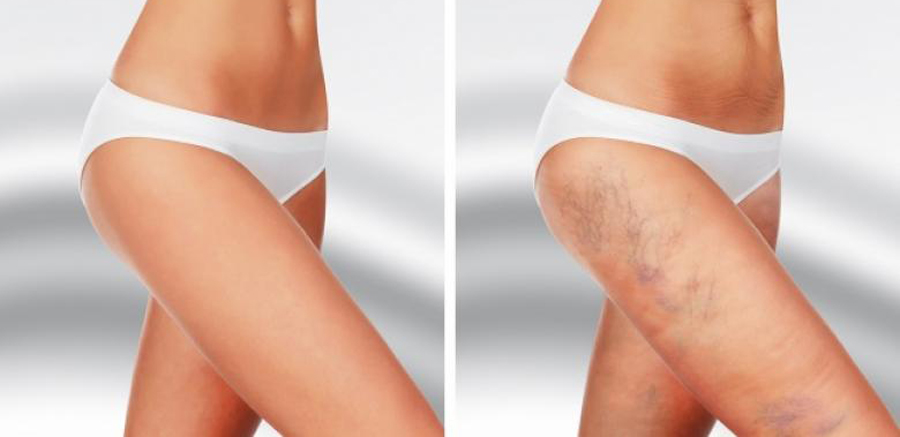 Имате необјасниви модринки на вашето тело? Еве кои здравствени проблеми можат да бидат причина за тоа