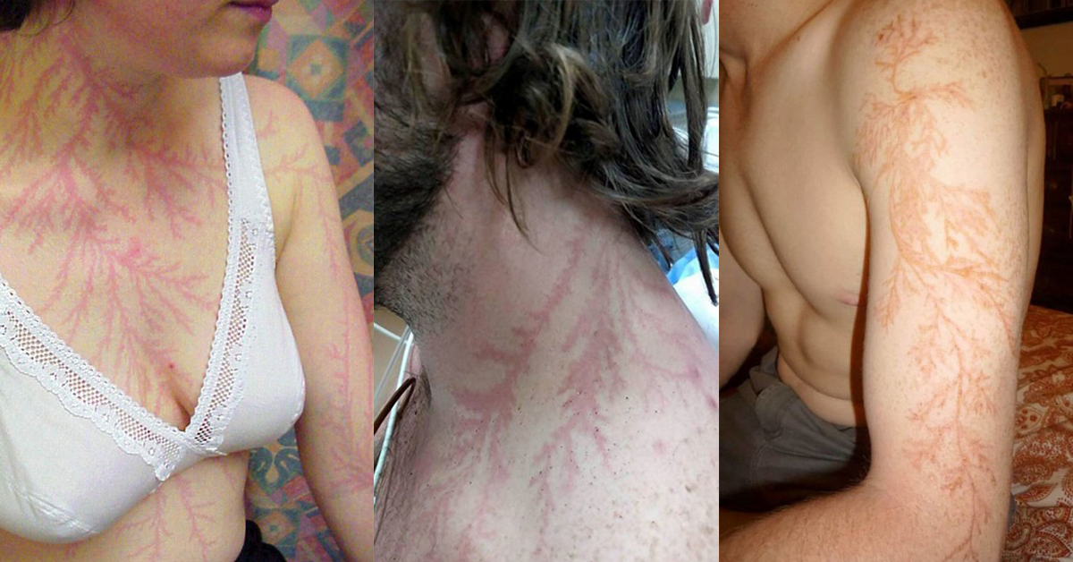 Луѓе што преживеале удар од молња покажуваат што тоа ѝ прави на вашата кожа