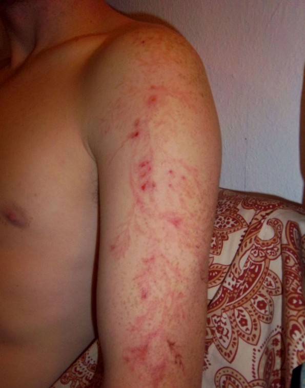 Луѓе што преживеале удар од молња покажуваат што тоа ѝ прави на вашата кожа