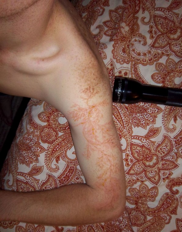 Луѓе што преживеале удар од молња покажуваат што тоа ѝ прави на вашата кожа