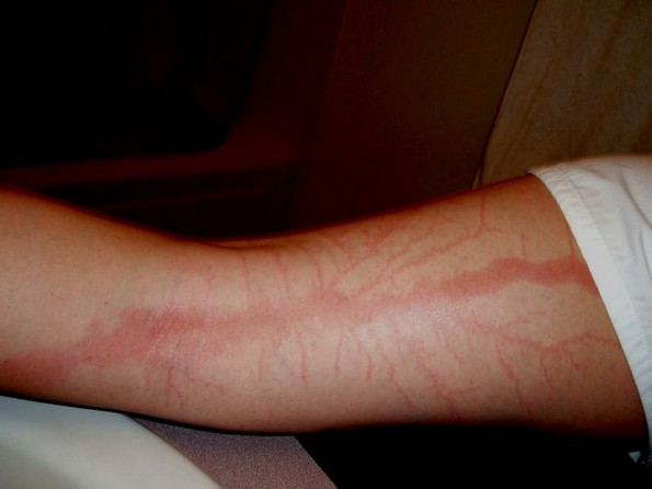 Луѓе што преживеале удар од молња покажуваат што тоа ѝ прави на вашата кожа