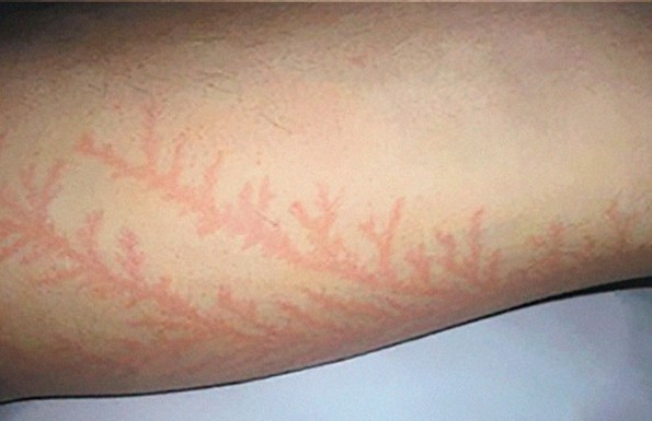 Луѓе што преживеале удар од молња покажуваат што тоа ѝ прави на вашата кожа