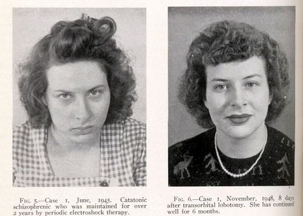 Морничави пред и потоа фотографии од луѓе на кои им била направена лоботомија