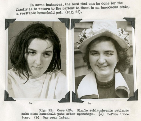 Морничави пред и потоа фотографии од луѓе на кои им била направена лоботомија