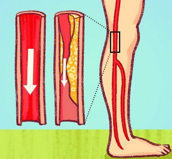 7 опасни знаци за блокирани артерии што често ги игнорираме