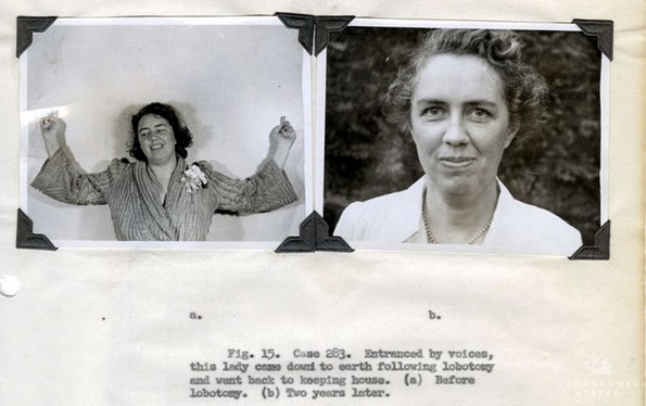 Морничави пред и потоа фотографии од луѓе на кои им била направена лоботомија