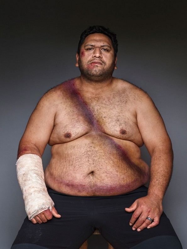 10 луѓе позираат со нивите повреди за да ја зголемат свесноста за безбедносниот појас