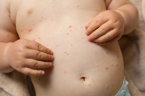 8 митови за вакцините кои предизвикаа епидемија на морбили во 21-виот век