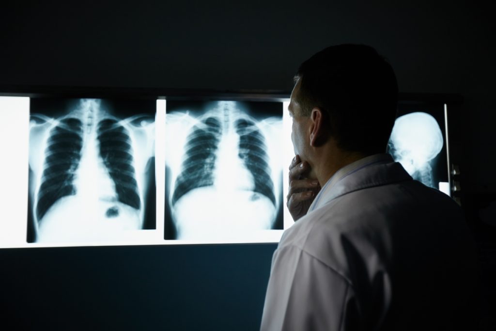 Симптоми на рак на белите дробови на кои треба да внимавате дури и ако не сте пушач