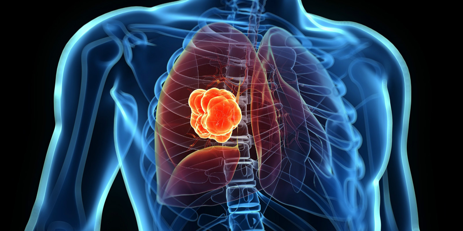 Експертите предупредуваат: Загадувањето поврзано со илјадници случаи на рак на белите дробови