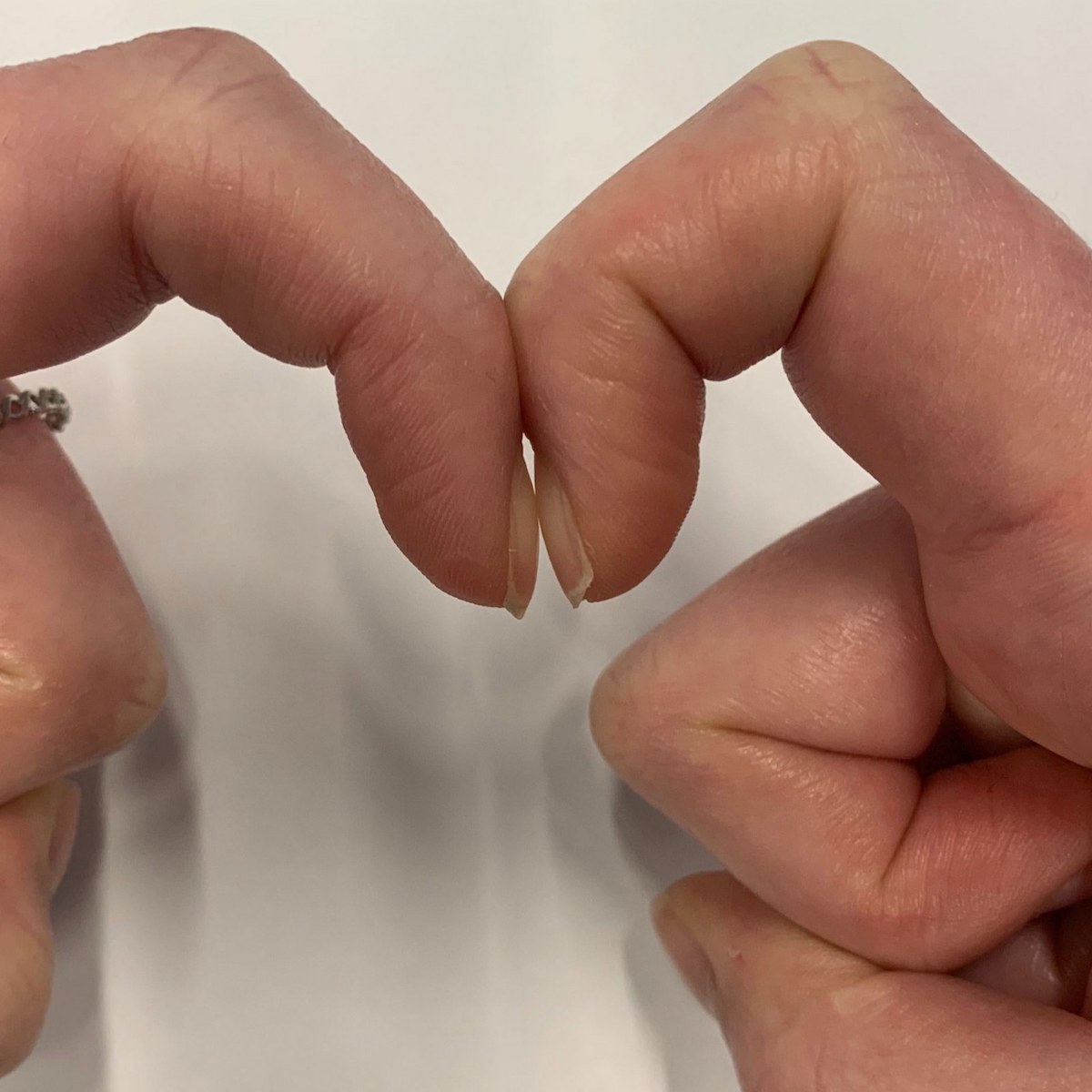 Спојте ги прстите на овој начин и за неколку секунди дознајте дали ви се заканува рак на белите дробови: Овој едноставен тест може да ви го спаси животот