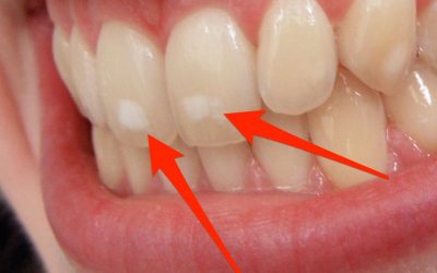 Бели дамки на забите, зошто некои луѓе ги имаат, а други не?