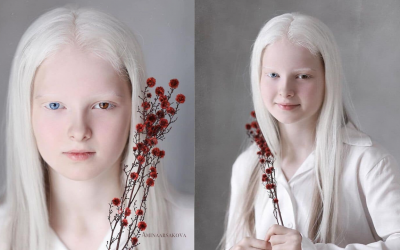 Портрети кои ја истакнуваат уникатната убавина на една девојка со албинизам и хетерохромија