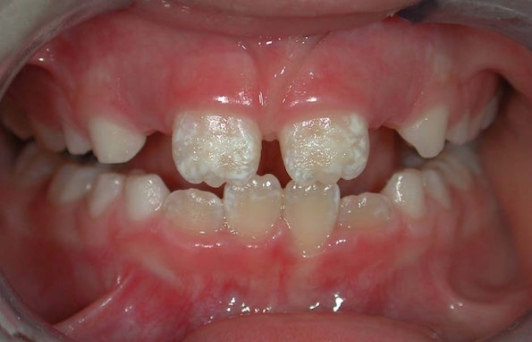 Што е подобро за забите на Вашето дете: Доење или формула?