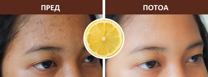 7 намирници што ги намалуваат лузните од акни