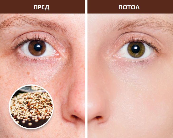 7 намирници што ги намалуваат лузните од акни