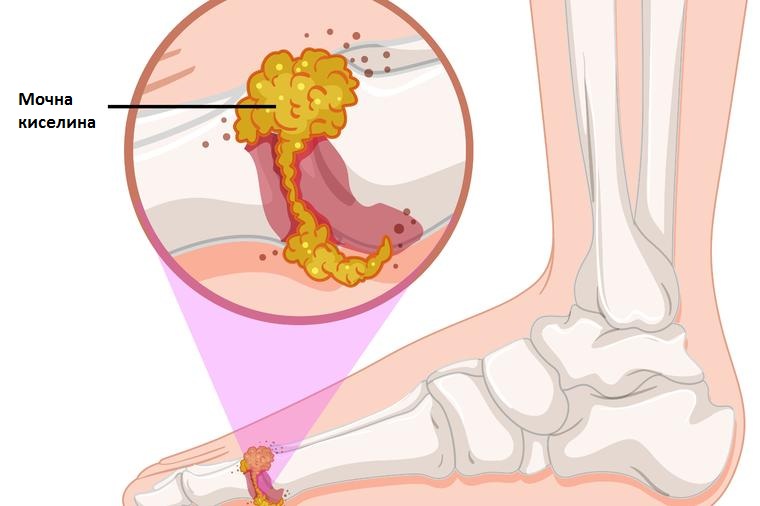 Како да ја отстраните мочната киселина од телото?