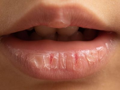 Што ќе се случи со вашите усни ако користите балсам за усни премногу често?