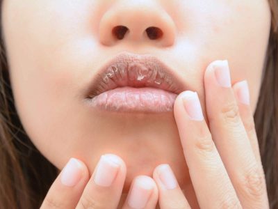 Ве мачат испуканите усни? Овие домашни лекови ќе ви помогнат да ги излечите!